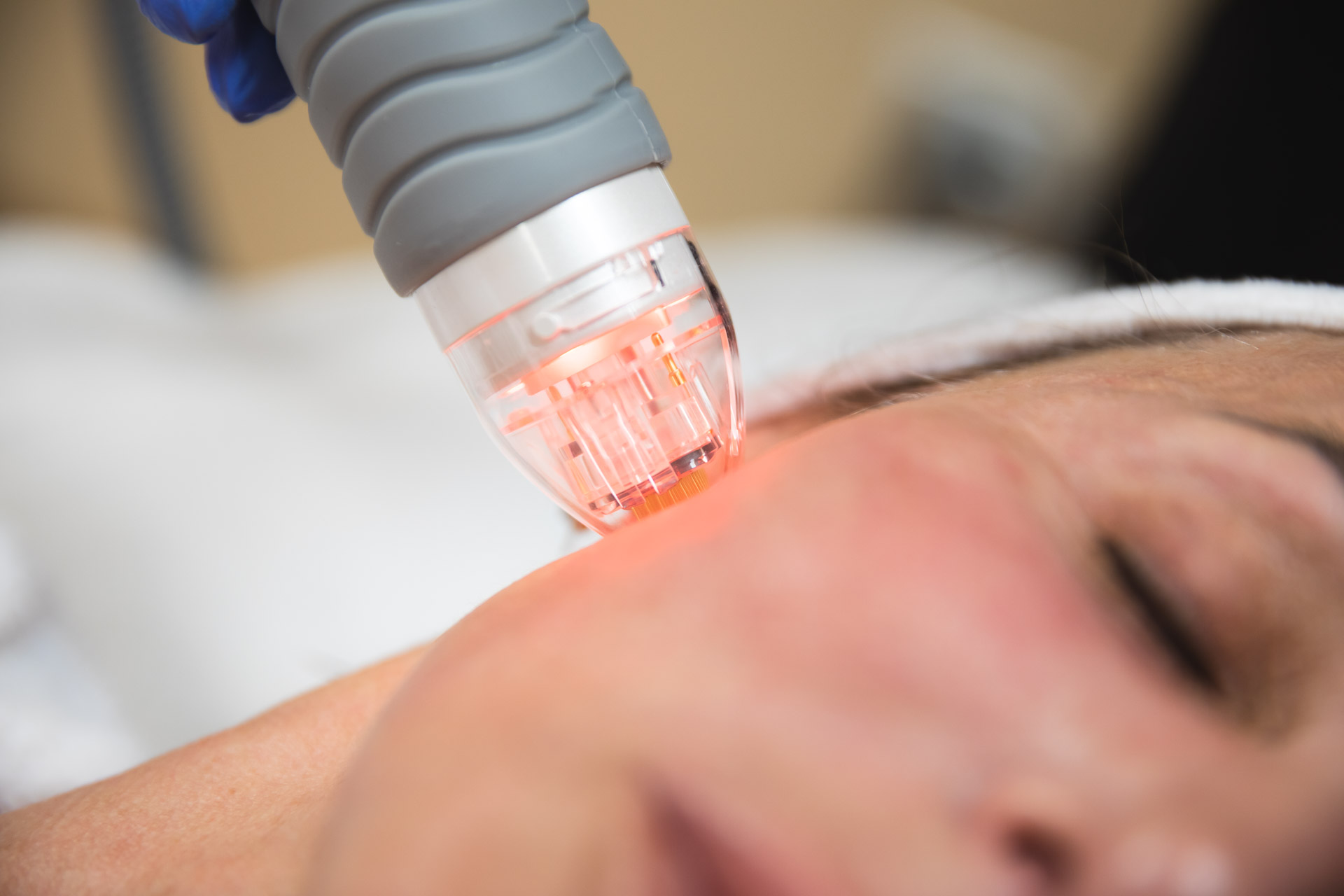 A female patient at Vitality Medical Wellness Center laying down with her eyes closed while she receives a treatment of RF microneedling in Belle Meade, TN.