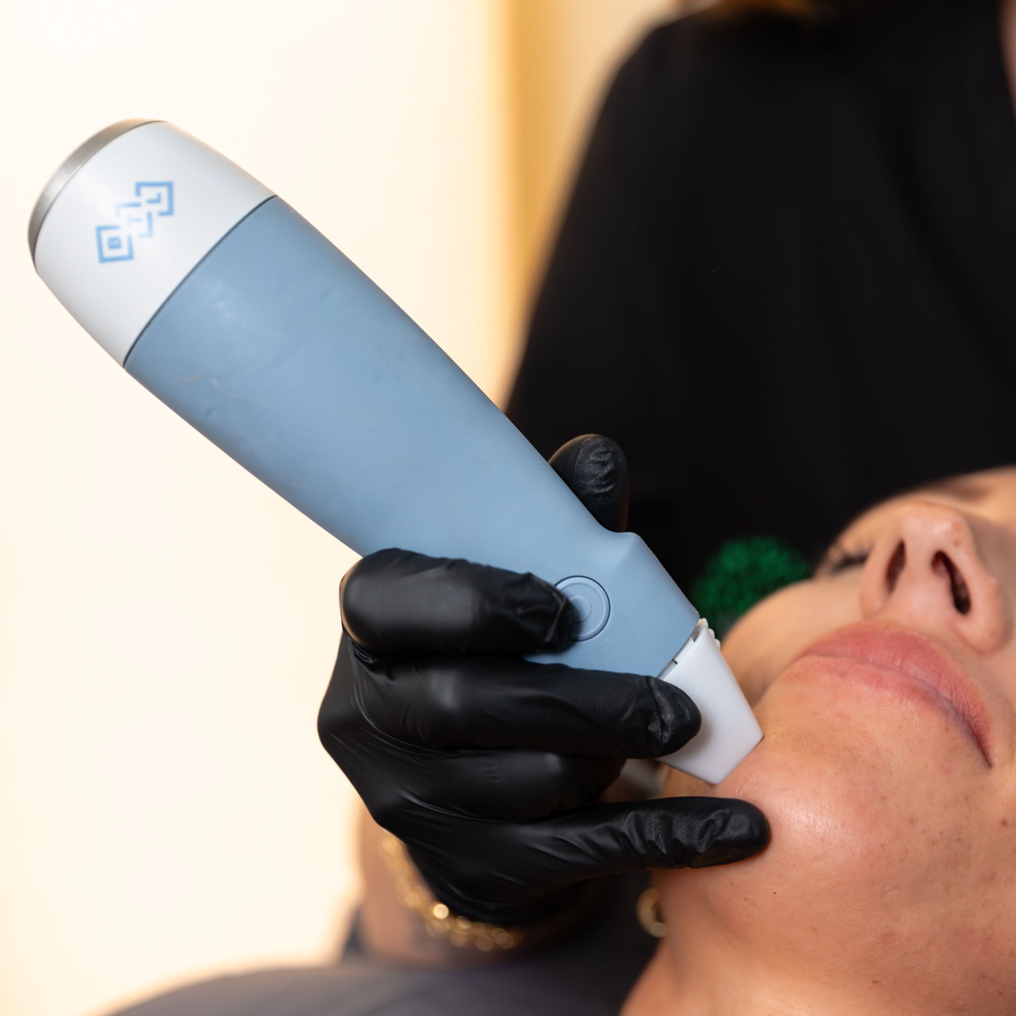 A provider at Vitality Medical Wellness Center using Exion hand piece to administer RF microneedling near Brentwood, TN.